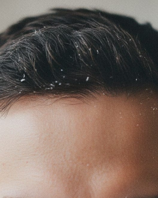 Example photograph: a hairline and forehead, close up, with three numbered squares on the hair, the forehead and the skin beside it.
